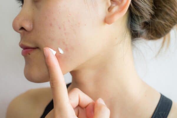 acne scars natural